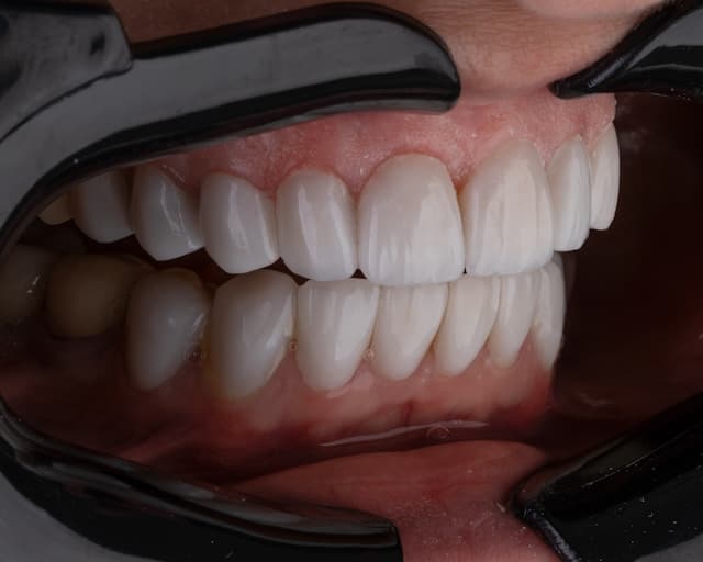 La importancia de la periodoncia: cuidar las encías es tan importante como cuidar los dientes 6 clinica dental en Sevilla y periodoncia